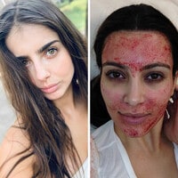Michelle Renaud relató que se hizo el famoso 'facial vampiro', que Kim Kardashian puso de moda en 2013