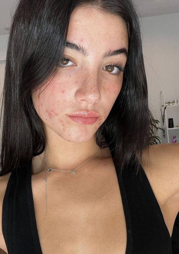 Charlie D Amelio No Edita Sus Fotos En Redes Para Visibilizar El Acne