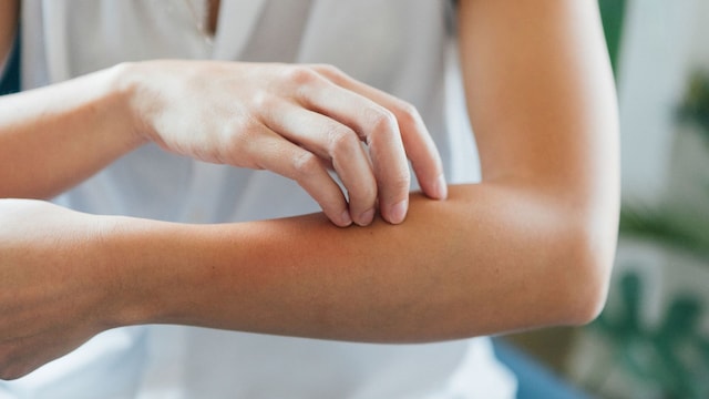 Mujer joven rascándose el brazo por la picadura de un mosquito en primer plano.