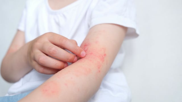 Niña rascándose lesiones de dermatitis atópica en el brazo