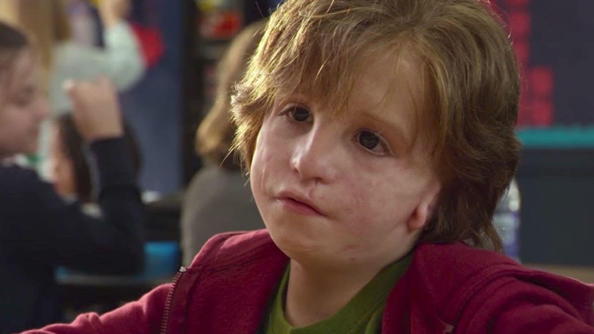 Síndrome de Treacher Collins, una enfermedad cuyo tratamiento depende de los avances tecnológicos