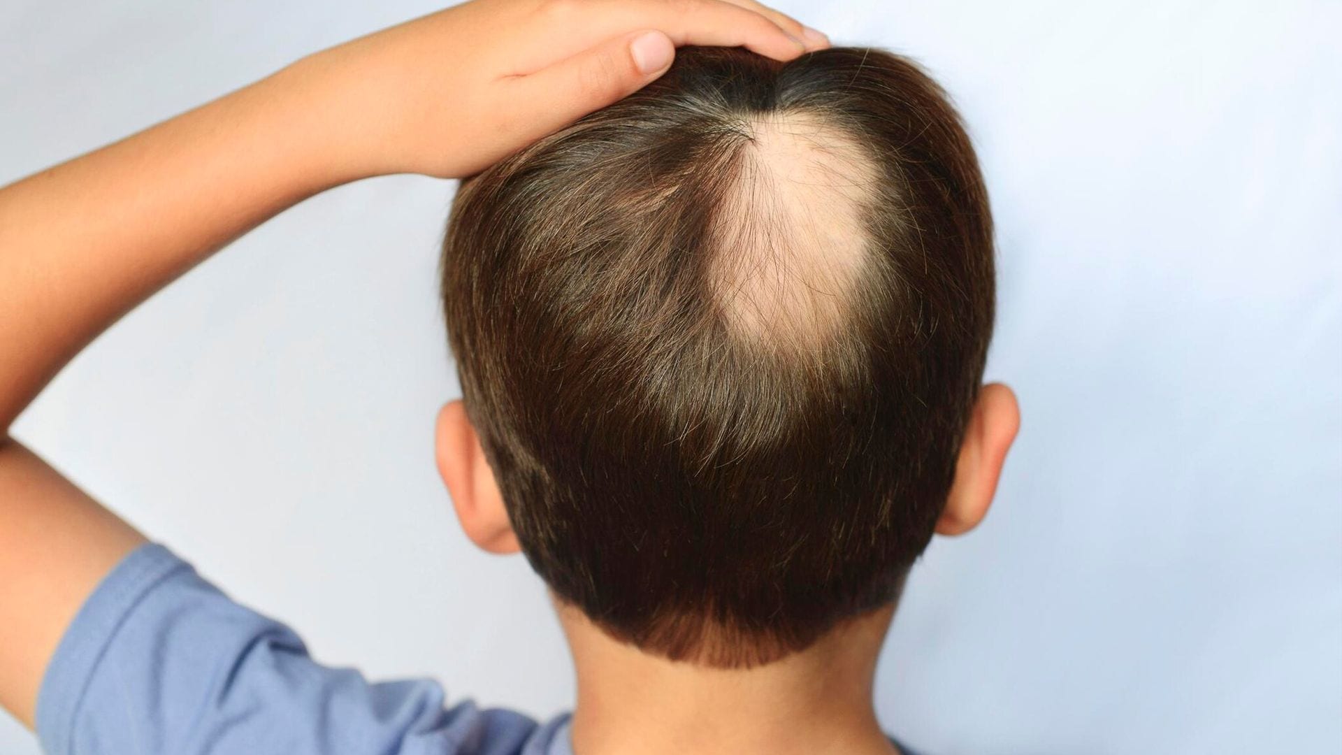 La alopecia areata, una enfermedad que hace que los menores de edad desarrollen calvicie