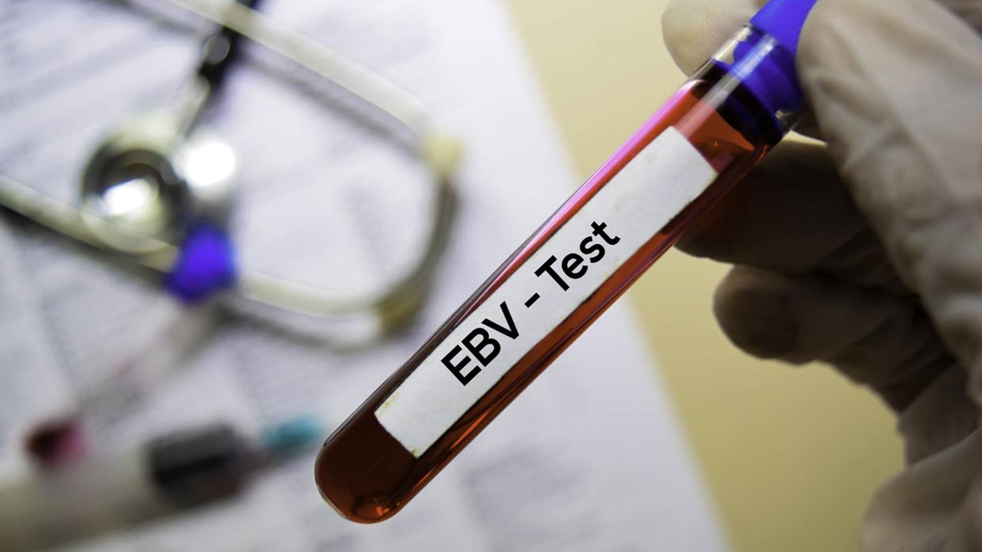 El virus responsable de la 'enfermedad del beso', posible causa de la esclerosis múltiple