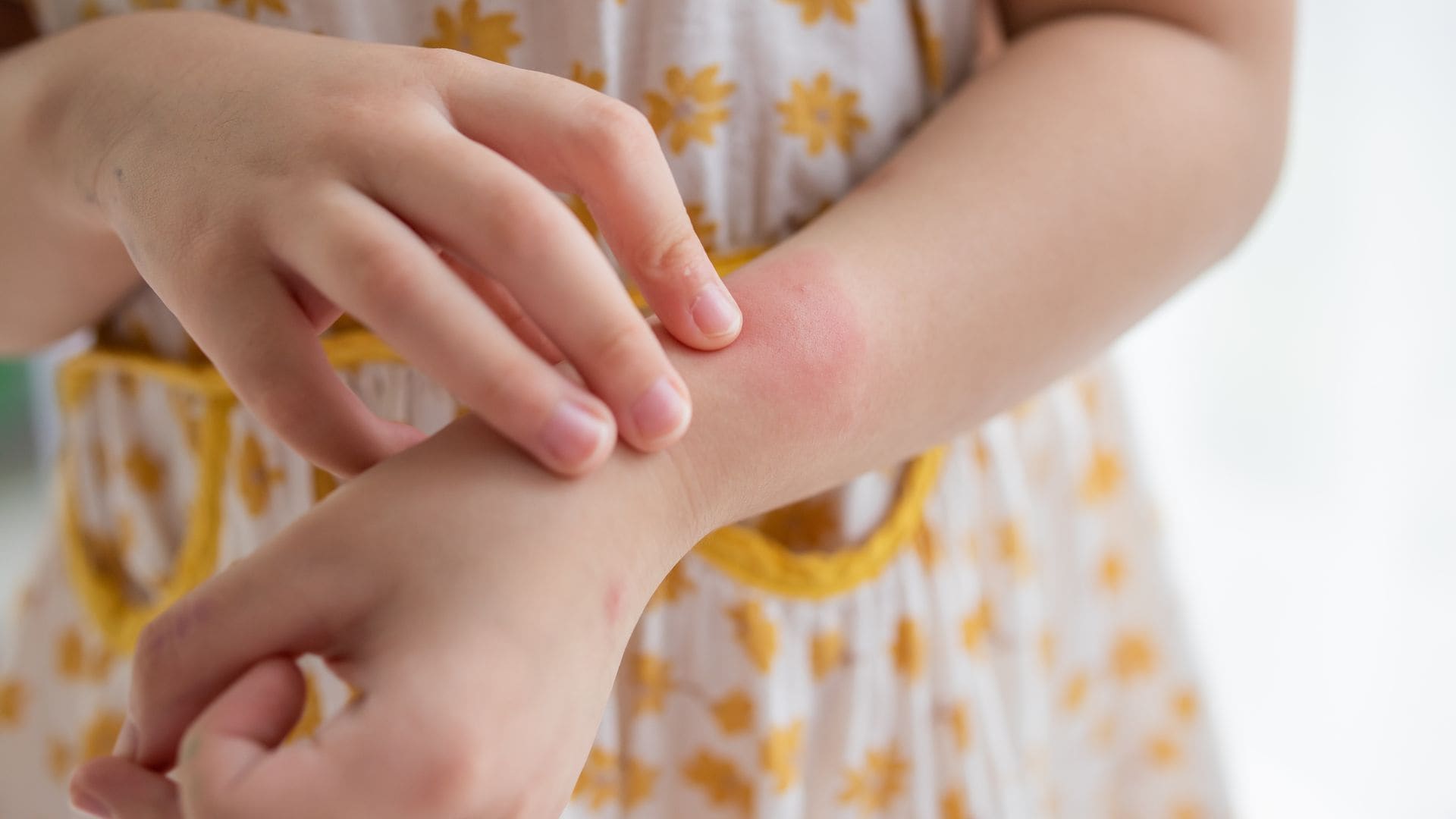 Niña con urticaria en brazo rascándose