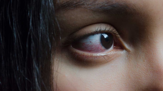 ojo irritado