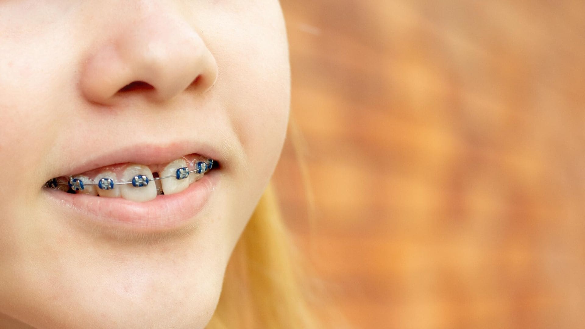 Diastema dental, ¿puede ser un riesgo para la salud?