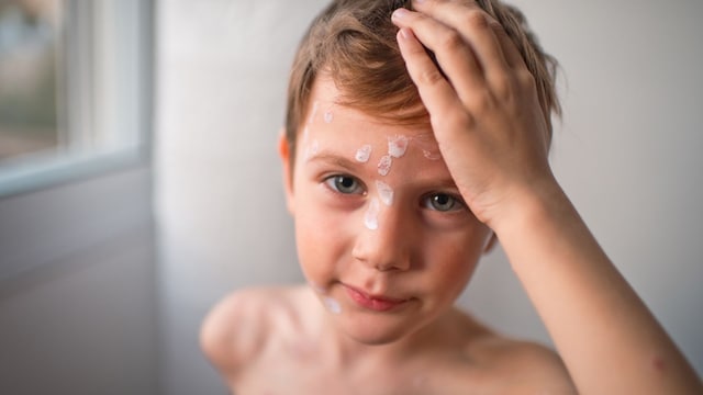 Niño con crema para curar manchas en la piel