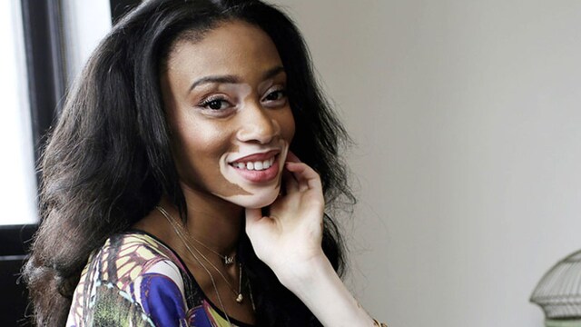 vitiligo_