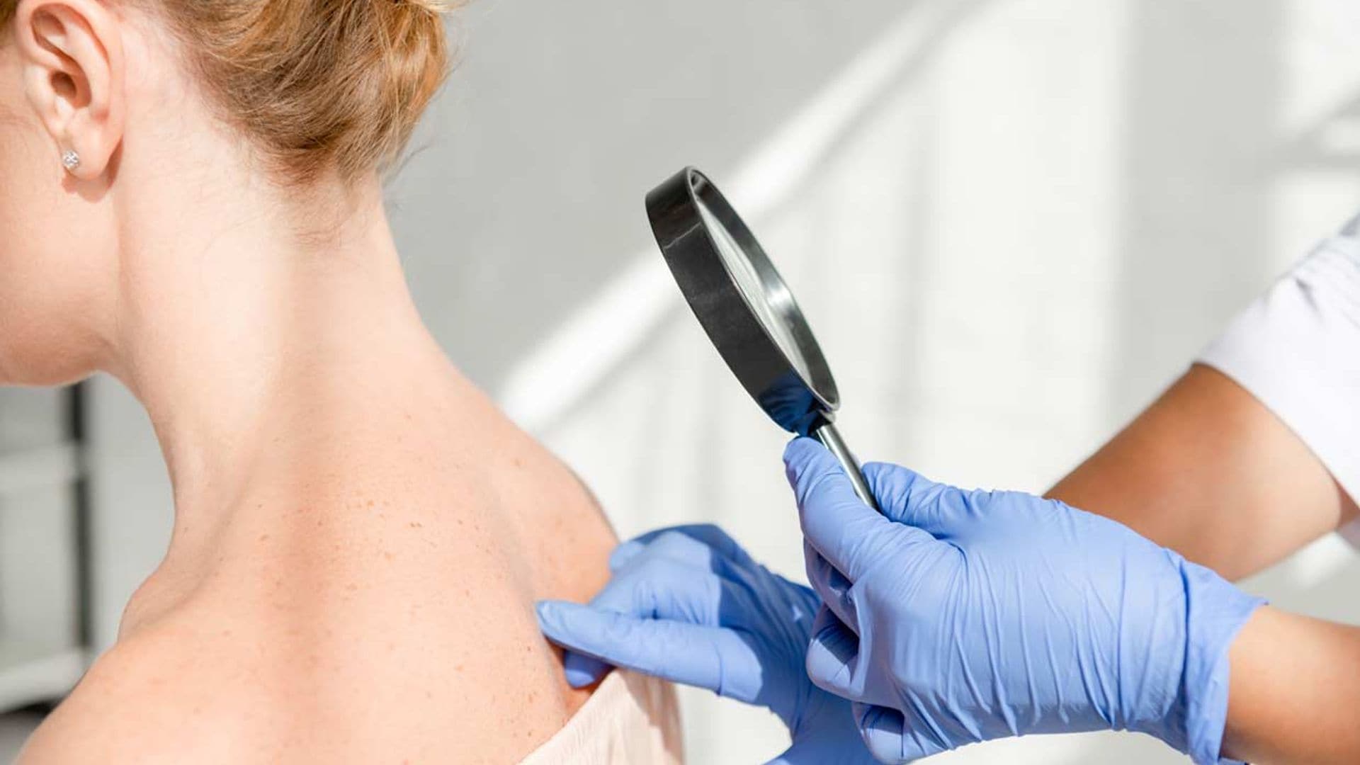 ¿Qué síntomas indican que puedes tener neurofibromatosis?