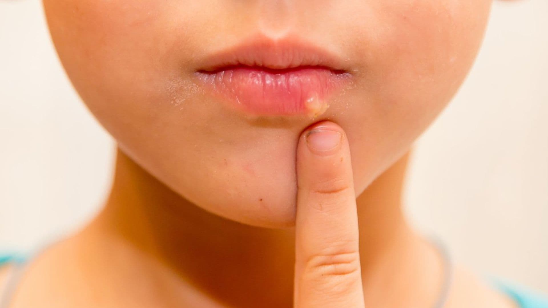 Herpes labial infantil, ¿consecuencia de un resfriado?