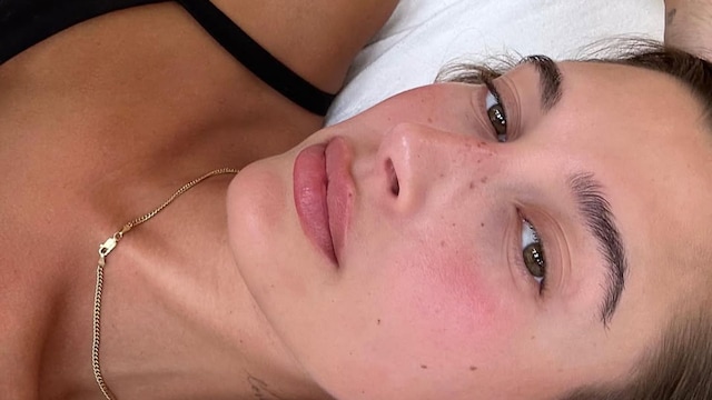 Hailey Bieber dermatitis