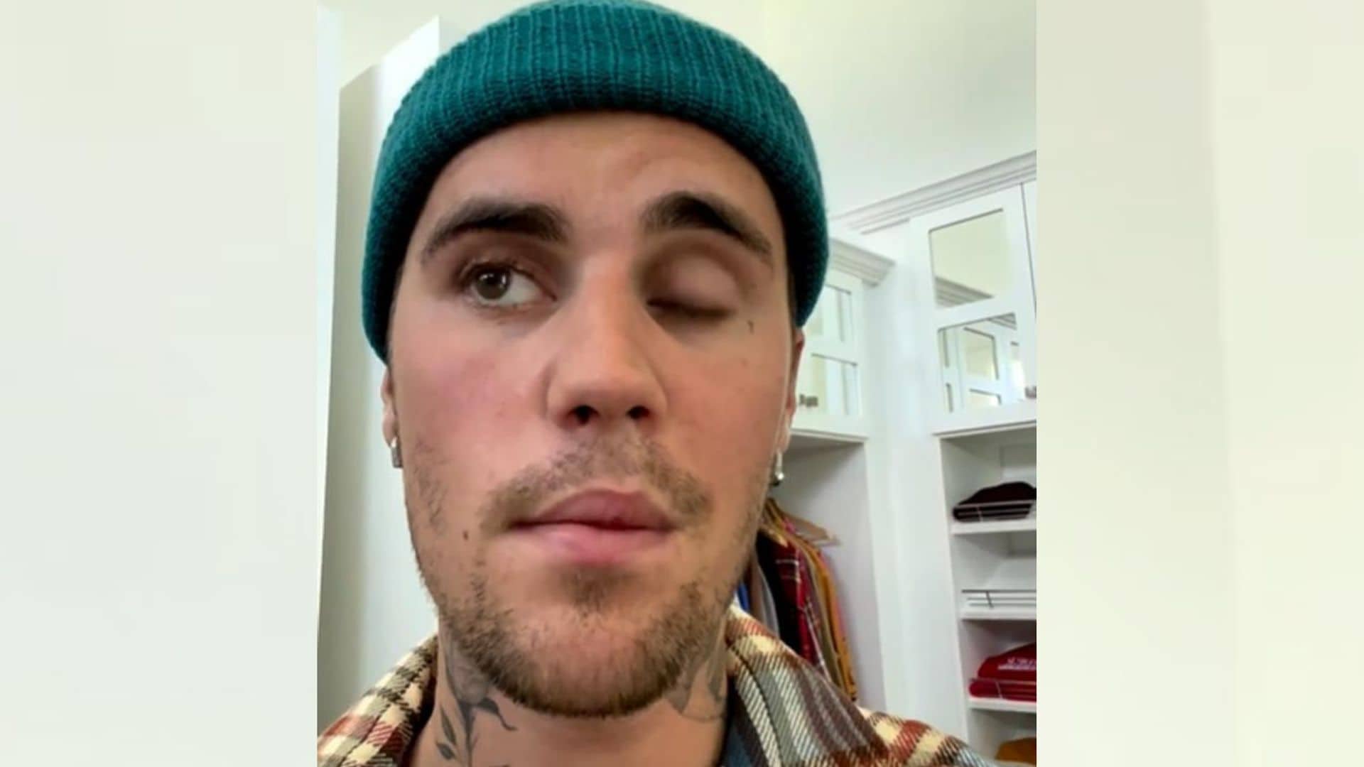 Justin Bieber comparte cómo evoluciona la incapacitante parálisis facial que sufre