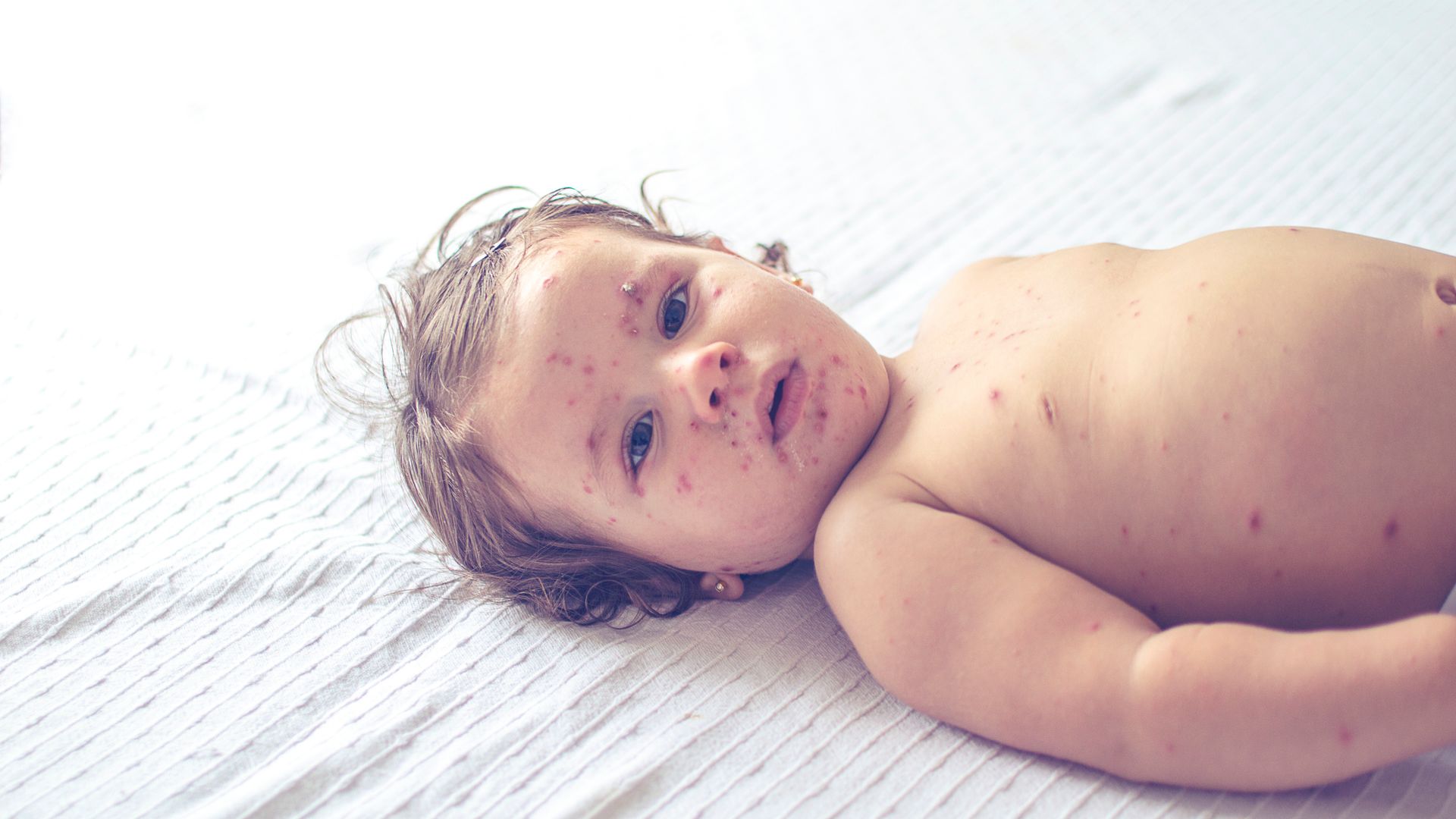 Niña con sarampión