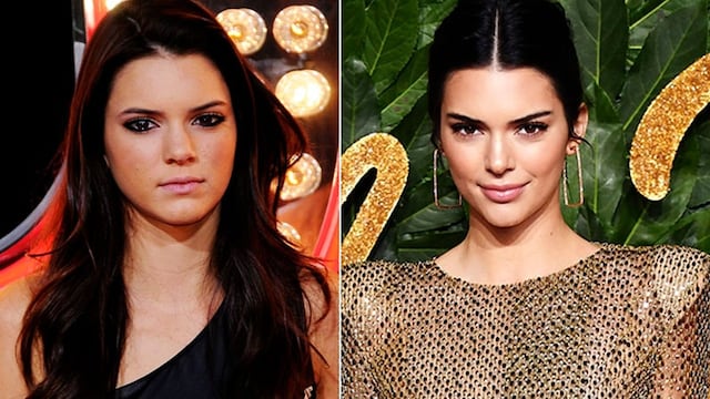 kendall jenner acne antes despues t