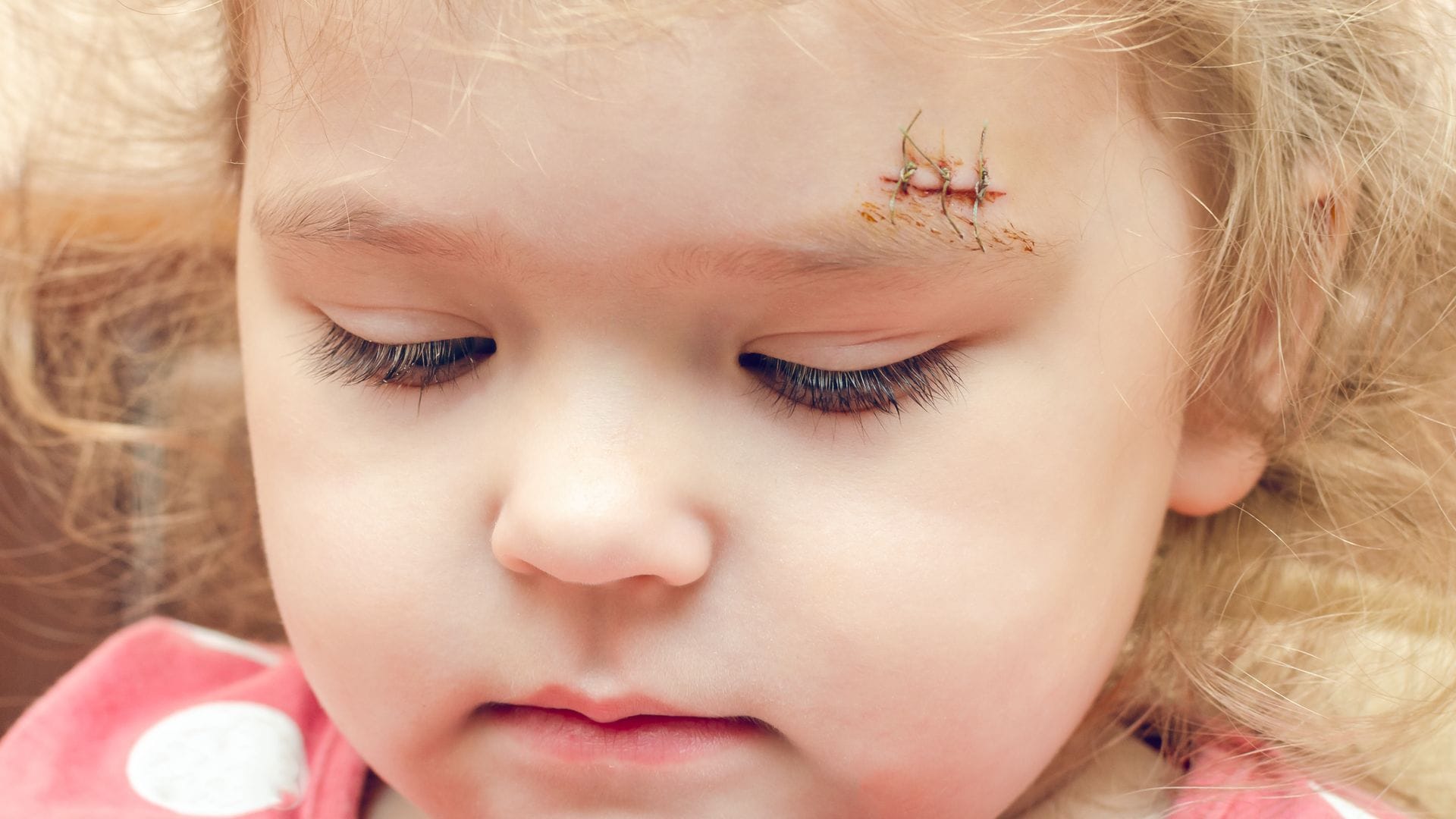 Niña con una cicatriz en la cara