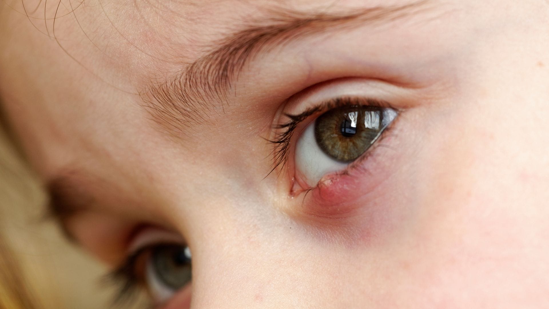 Niña con un orzuelo