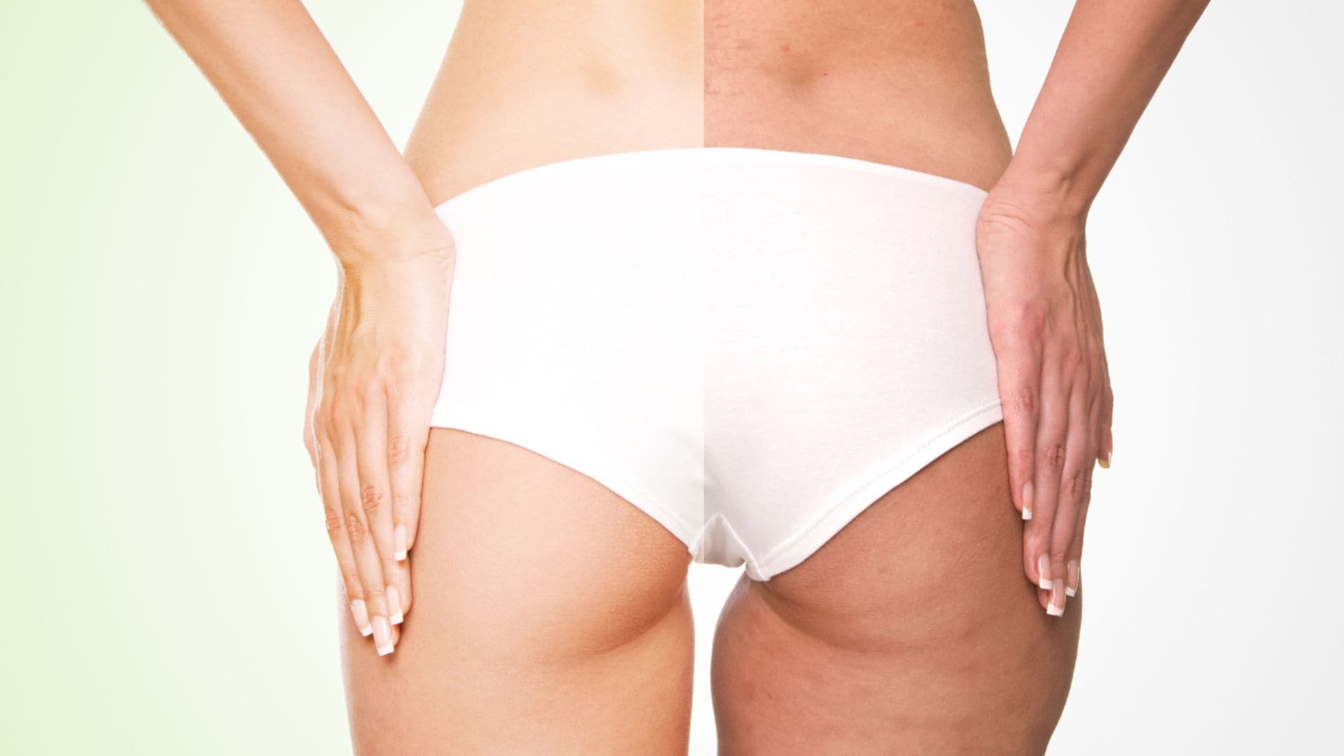 celulitis