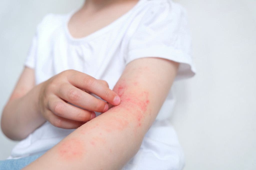 Niña rascándose lesiones de dermatitis atópica en el brazo