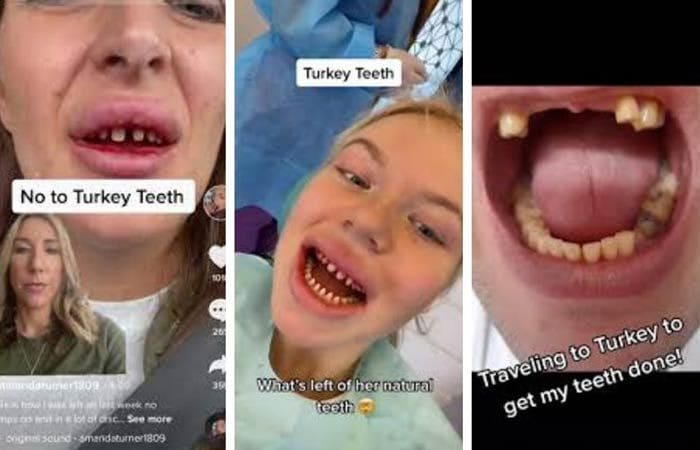 dientes turcos