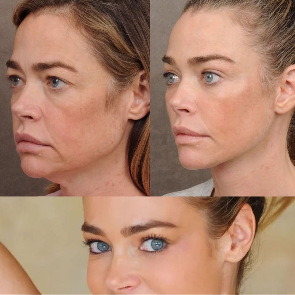 El antes y el después de Denise Richards