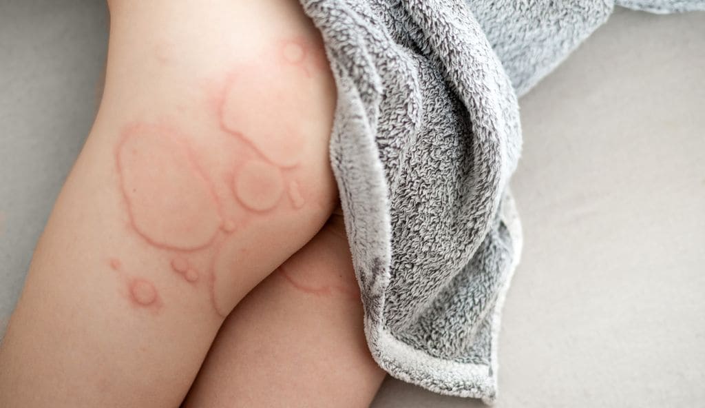 Habones en la piel de niño por urticaria