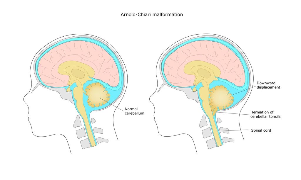 Malformación de Arnold-Chiari.