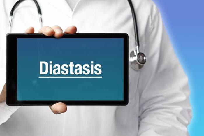 diástasis