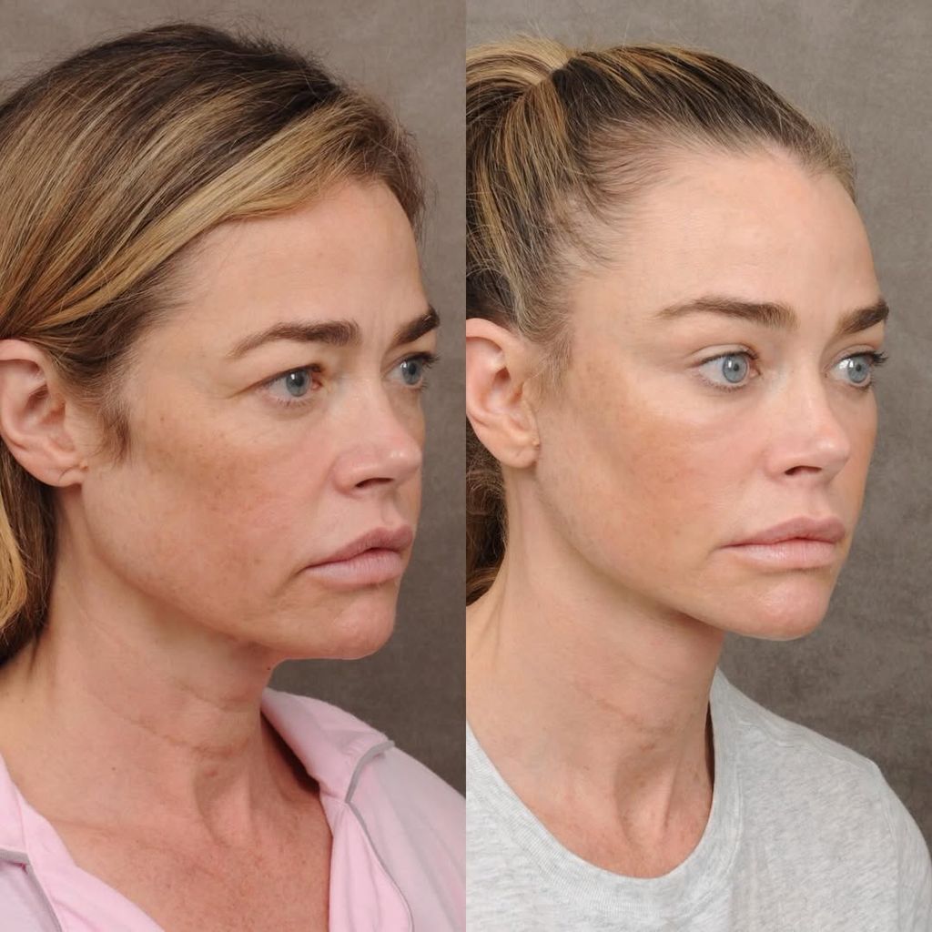 El antes y el después de Denise Richards