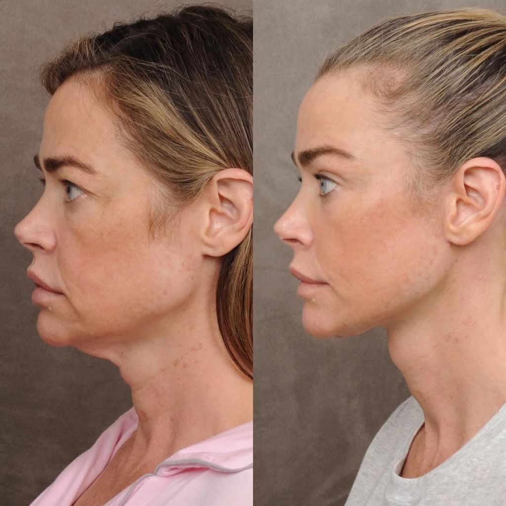El antes y el después de Denise Richards