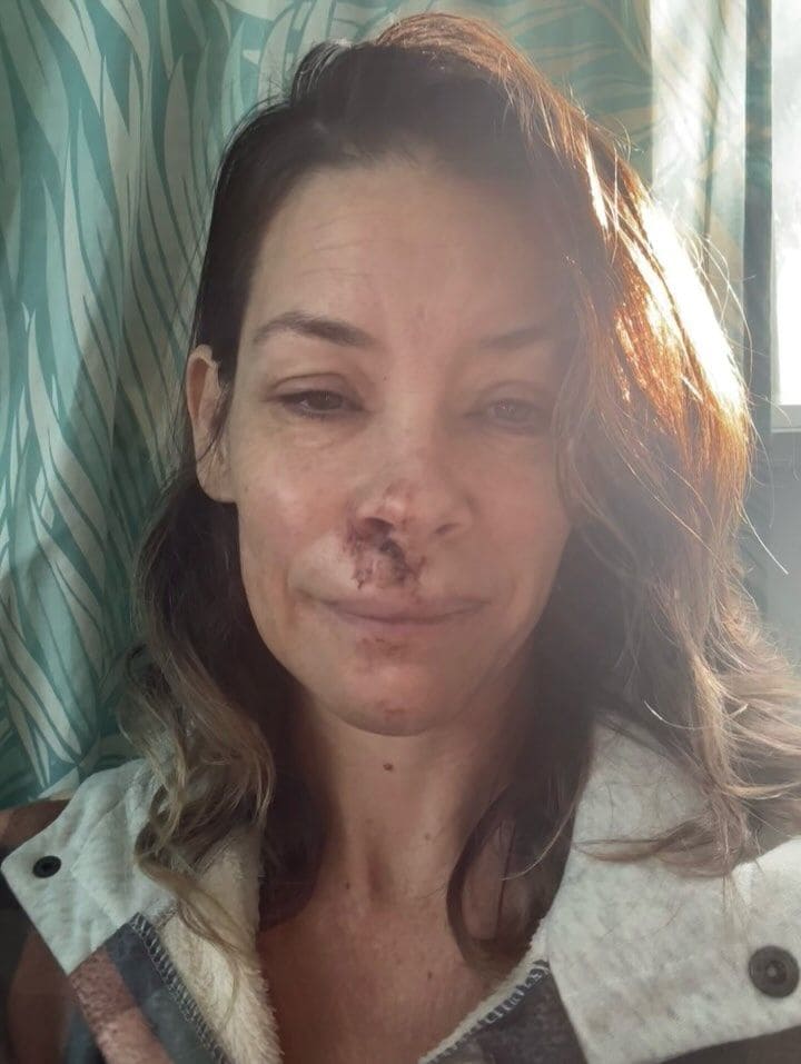Evangeline Lilly mostró las heridas tras la caída 