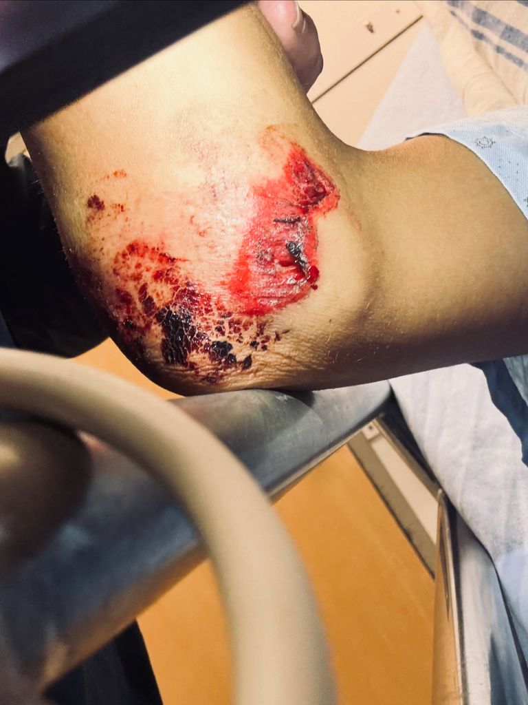 Las heridas de la ciclista tras el accidente