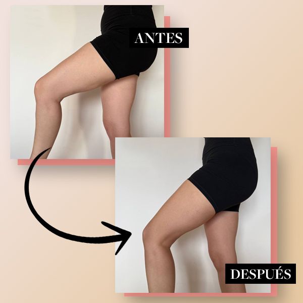 Piernas con celulitis antes y después