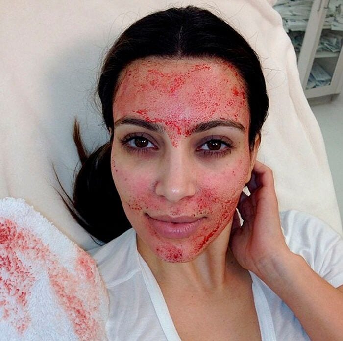 kim kardashian vampiro facial a