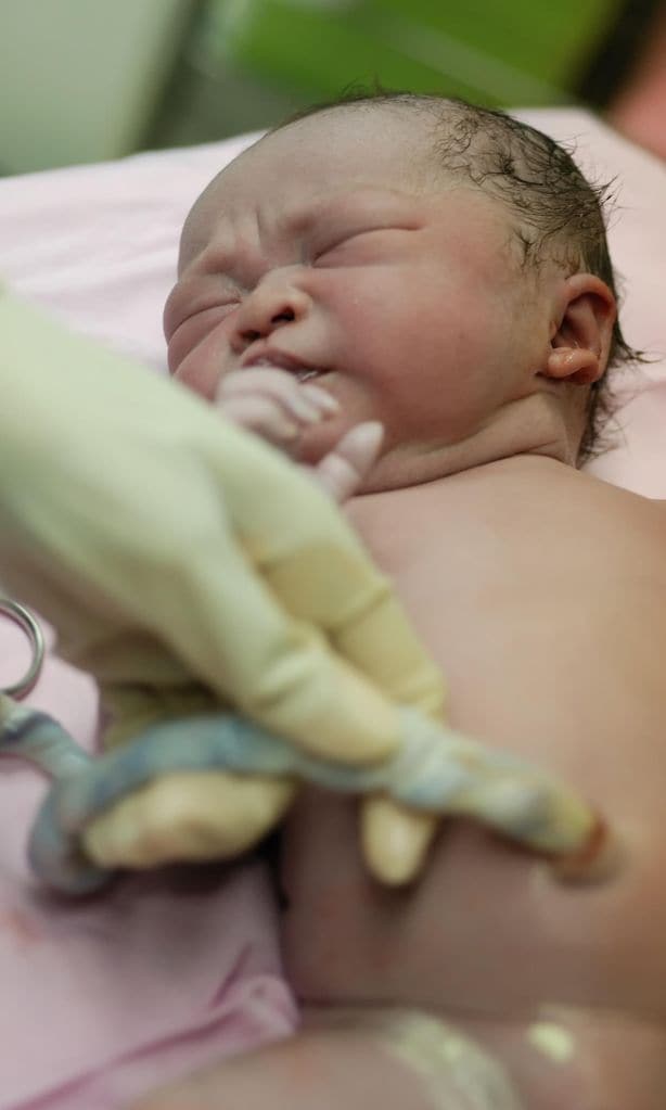 Pinzamiento tardío del cordón umbilical