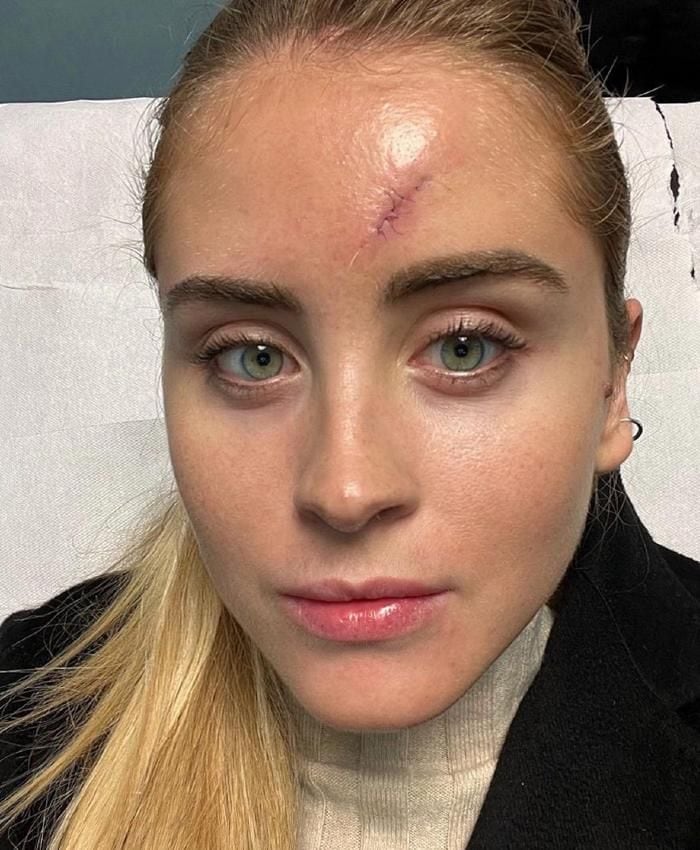 Valentina Ferragni tras la cirugía 