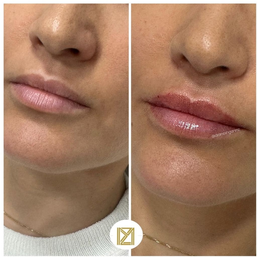 La técnica Moss Lips