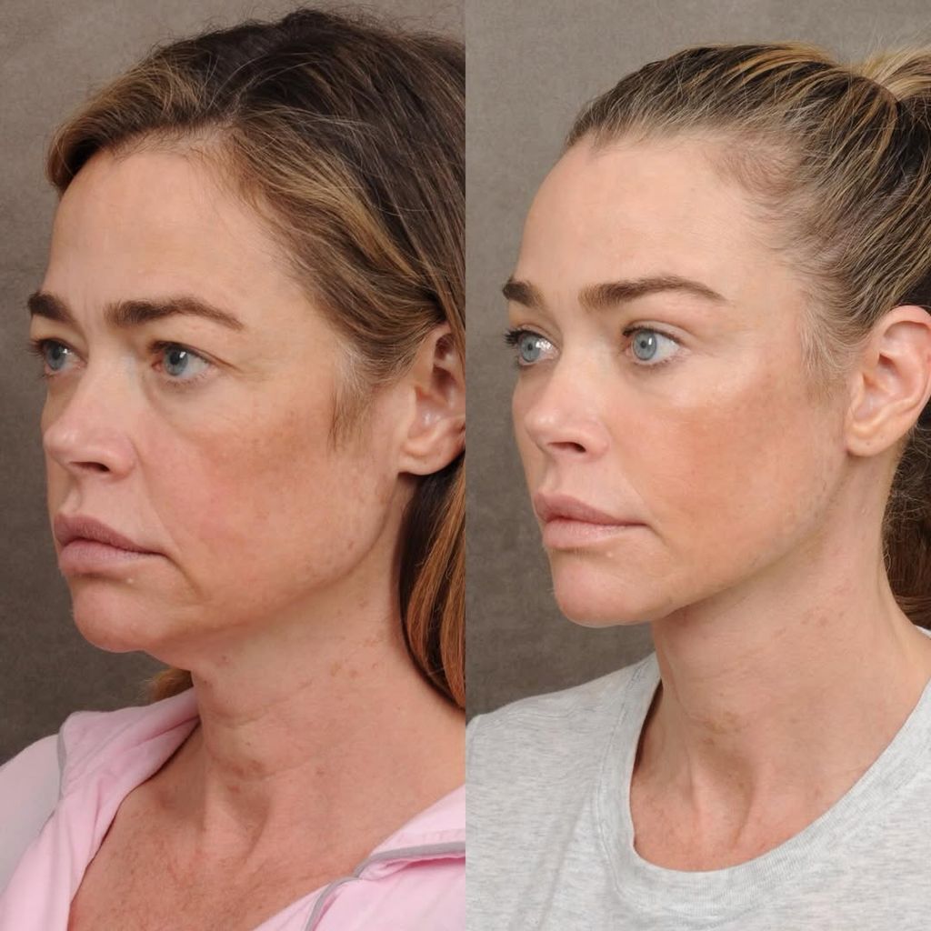 El antes y el después de Denise Richards tras su última cirugía