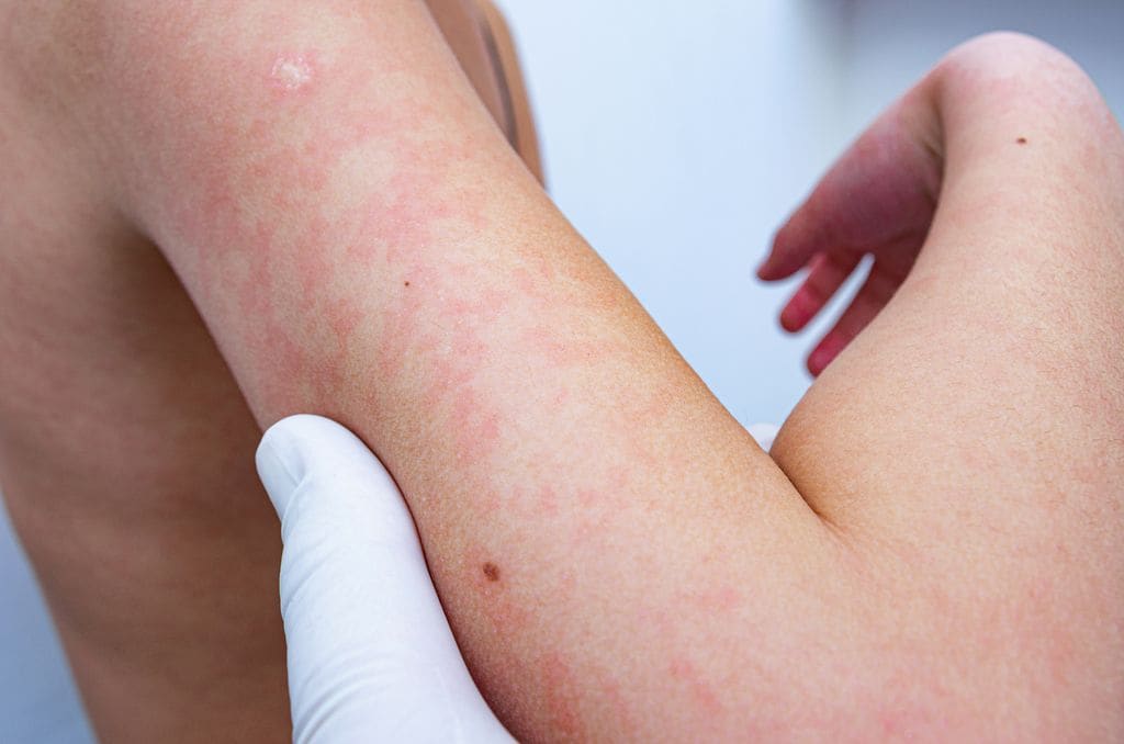 Urticaria en brazo de niño