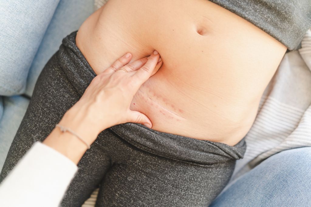 mujer con una cicatriz de una cesárea