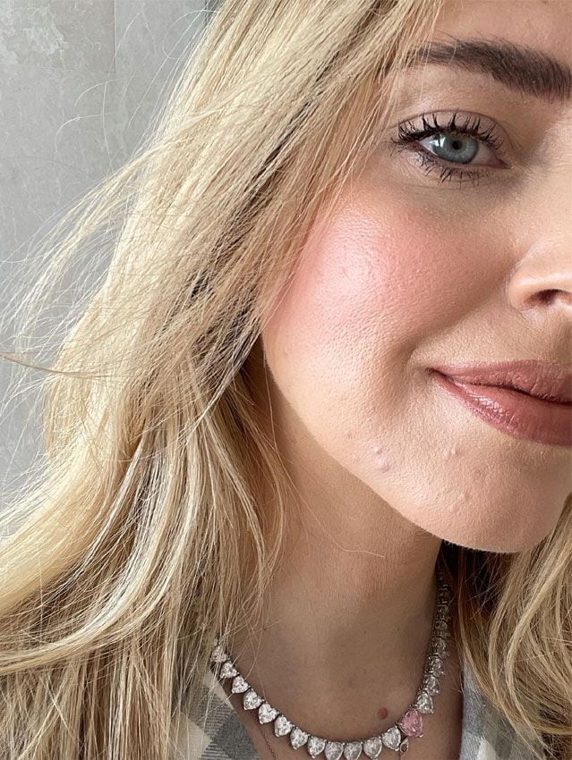 Chiara Ferragni se sincera sobre su acné en un momento difícil para familia