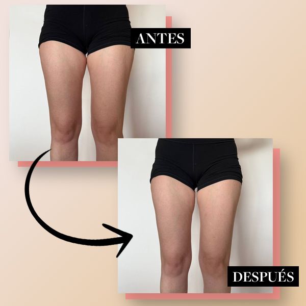 Piernas con celulitis antes y después