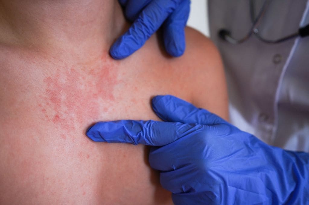 Niño con urticaria en el médico