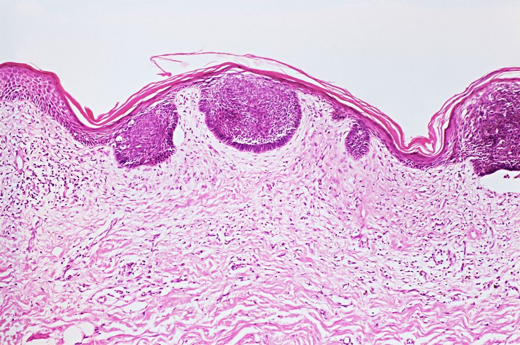 El carcinoma basocelular es el tipo más común de cáncer de piel y se origina en las células basales de la epidermis.