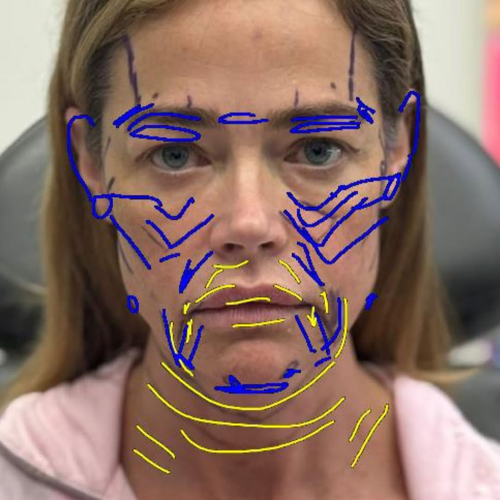 El antes y el después de Denise Richards