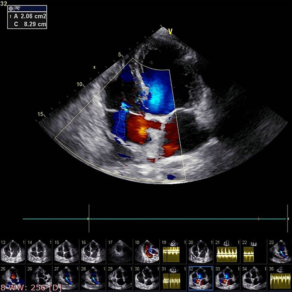 ecograf a doppler color y doppler pulsado