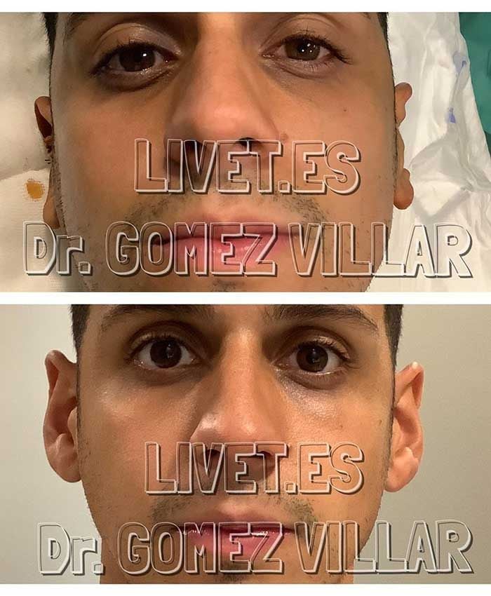 Christofer Guzmán se opera las orejas