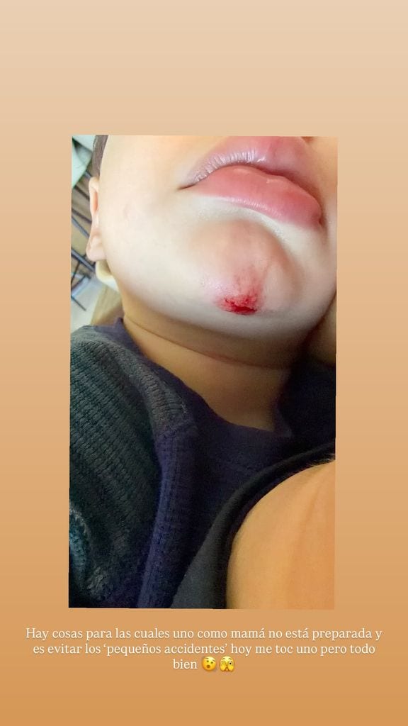 Lorenzo quedó con una marca en la barbilla que Daniela asegura que le duele más a ella