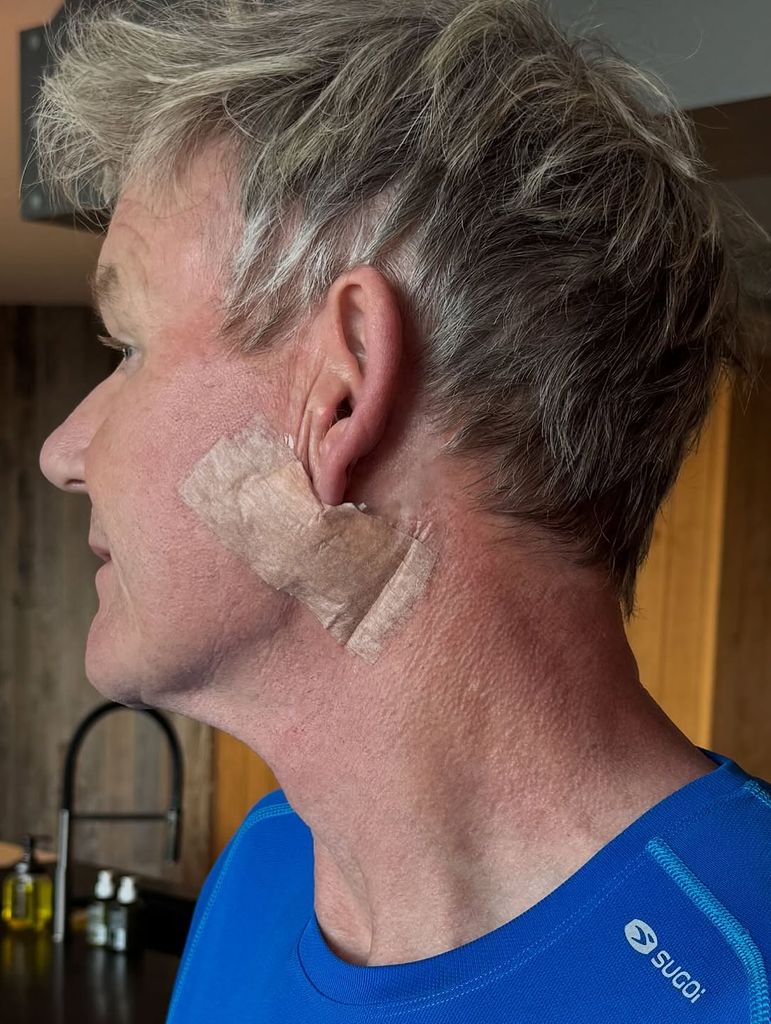 Para crear conciencia sobre las visitas médicas frecuentes y el uso del protector solar, el chef Gordon Ramsay compartió su experiencia con el cáncer de piel.