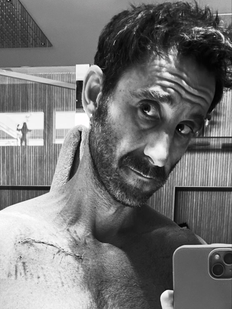 Dani Rovira muestra la cicatriz