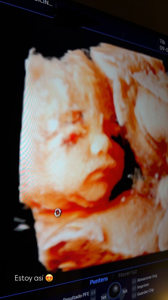 Ecografía de la bebé que espera Marta Castro y Rodri Fuertes